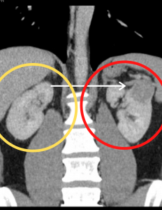 kidney-mass