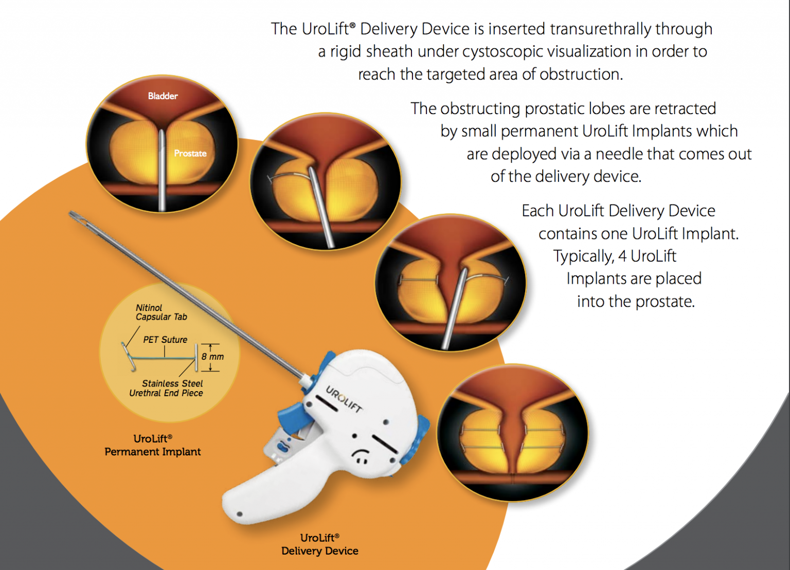 What Is A Urolift?